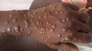 Read more about the article Watu 2 wathibitika kuwa na ugonjwa wa Mpox nchini